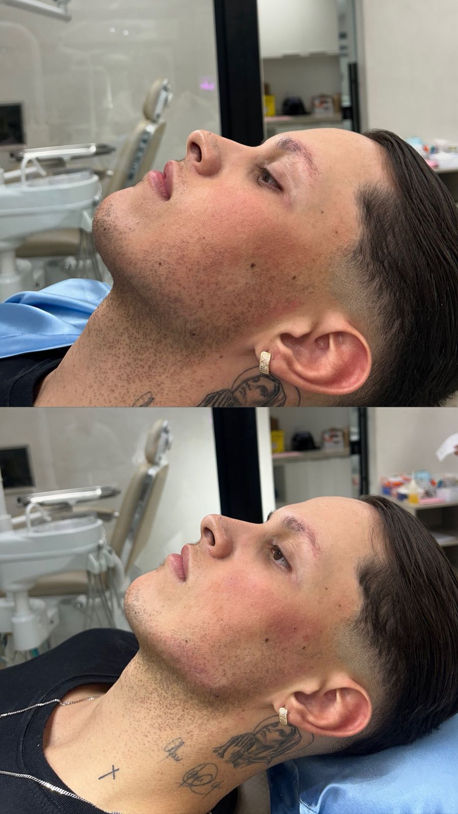 Resultado de contorno mandibular masculino — antes e depois